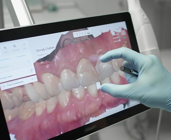 Dentist in Fort Lee reviewing a digital scan of a patient’s teeth before veneers